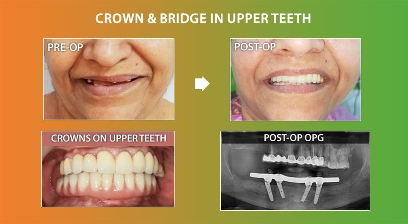 Crown in upper teeth