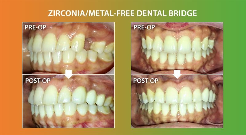 Zirconia Dental Bridge