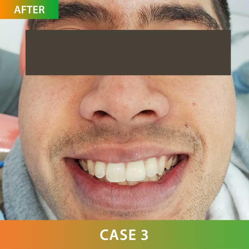 Zirconia Metal Free Crown