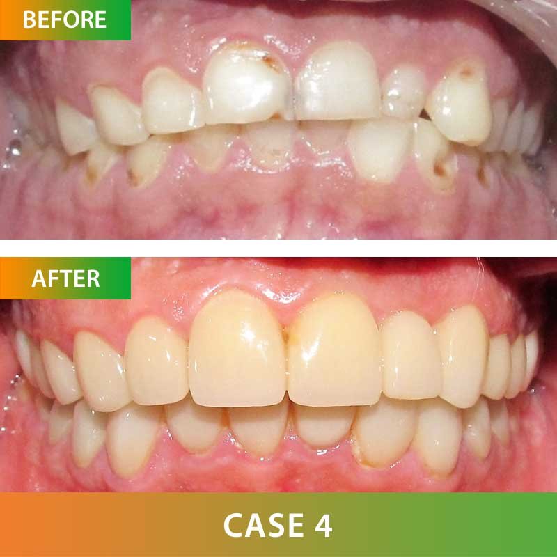 Zirconia Metal Free Crown