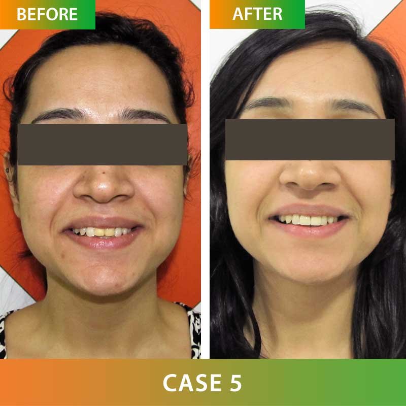 Zirconia Metal Free Crown