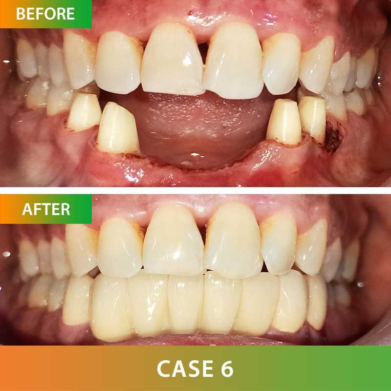 Zirconia Metal Free Crown