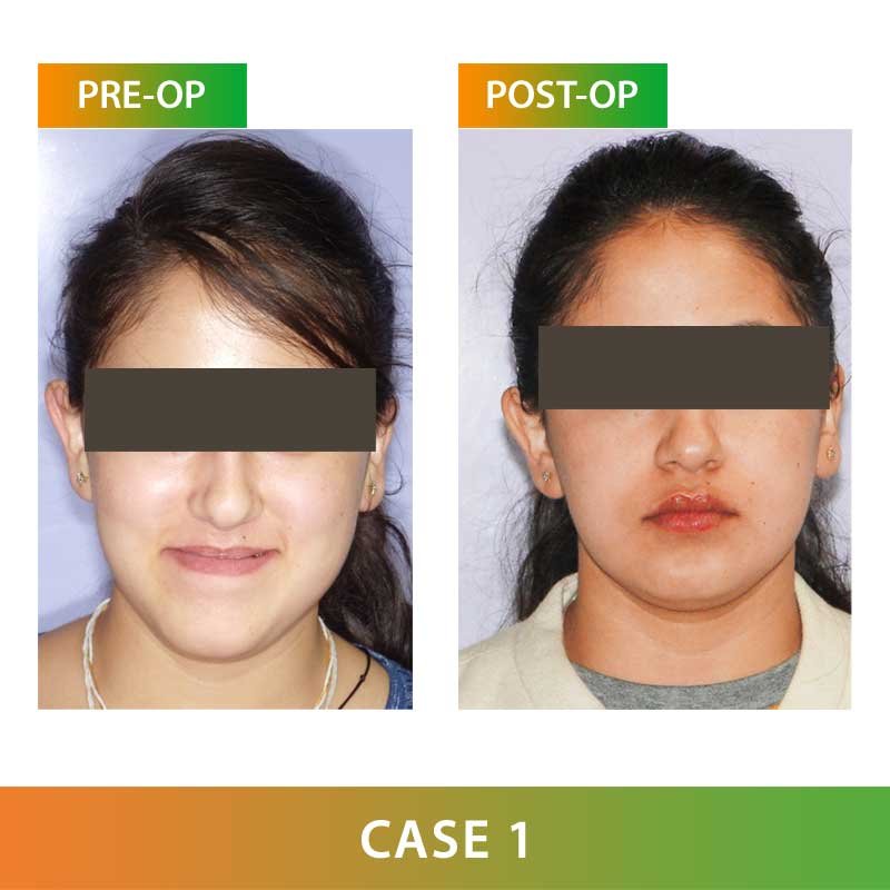 Major Orthognathic Surgery by Dr Ujjwal Gulati