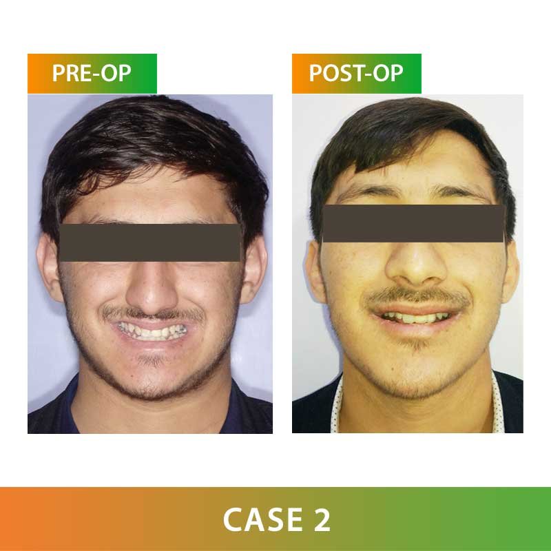 Major Orthognathic Surgery by Dr Ujjwal Gulati