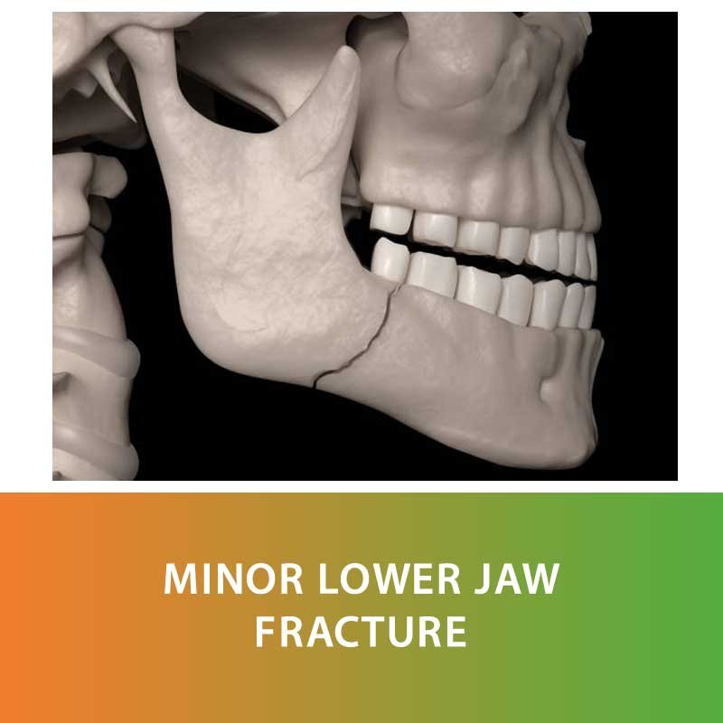 Minor Fractures of Jaws and Teeth Surgery