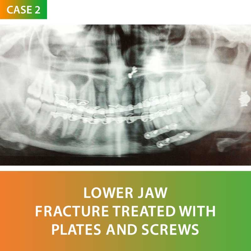 Minor Fractures of Jaws and Teeth Surgery