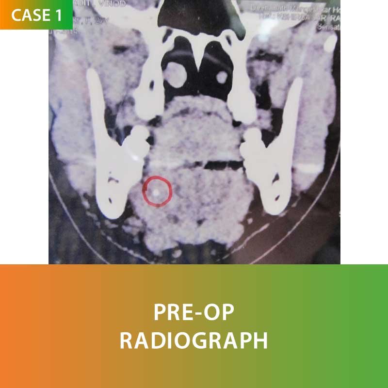 Salivary Gland Surgery by Dr Ujjwal Gulati