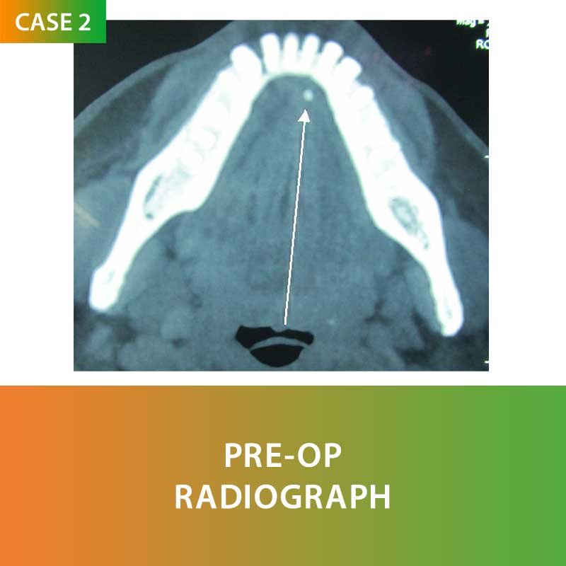 Salivary Gland Surgery by Dr Ujjwal Gulati