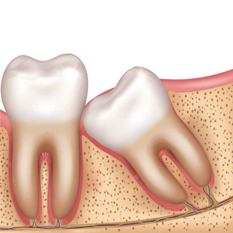 Wisdom molars and other impacted teeth minor surgery