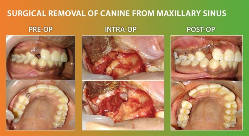 Surgical Removal Canine by Dr Ujjwal Gulati