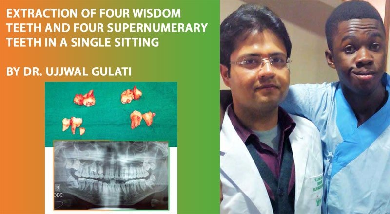 Wisdom Teeth Extraction in Single Sitting by Dr Ujjwal Gulati at Indiadens
