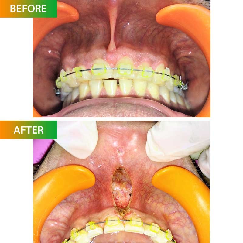Laser Dentistry Lip Pulls