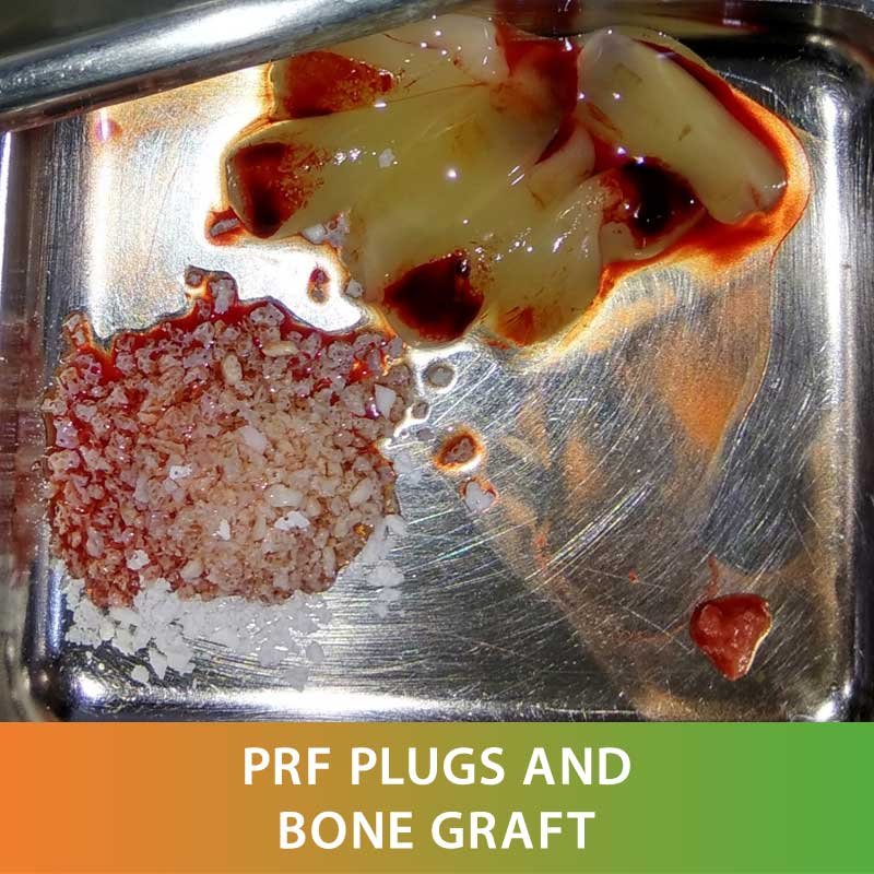 Advanced Dental Technology Platelet Rich Fibrin