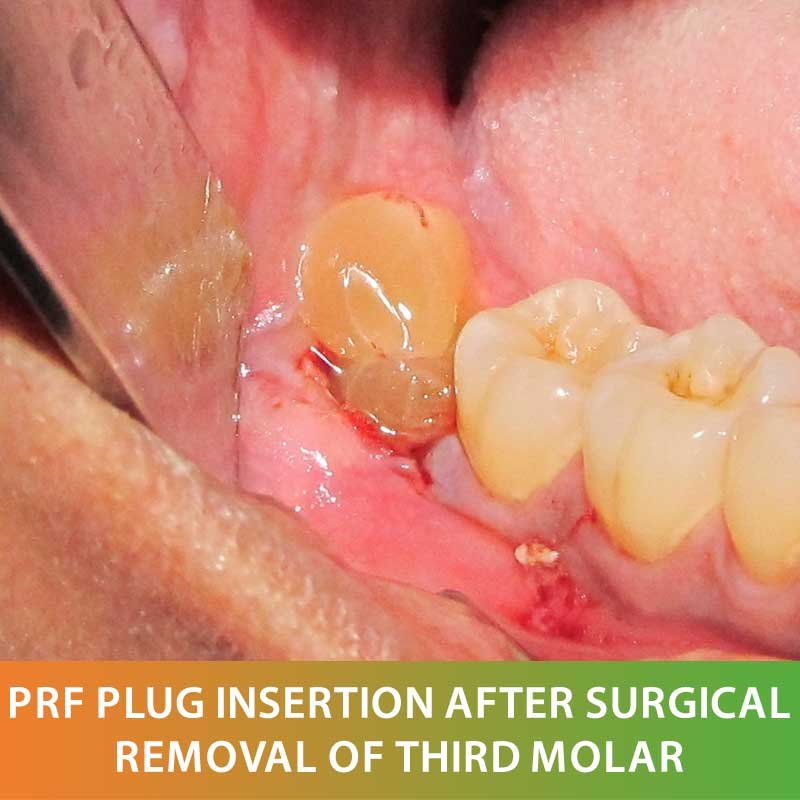 Advanced Dental Technology Platelet Rich Fibrin