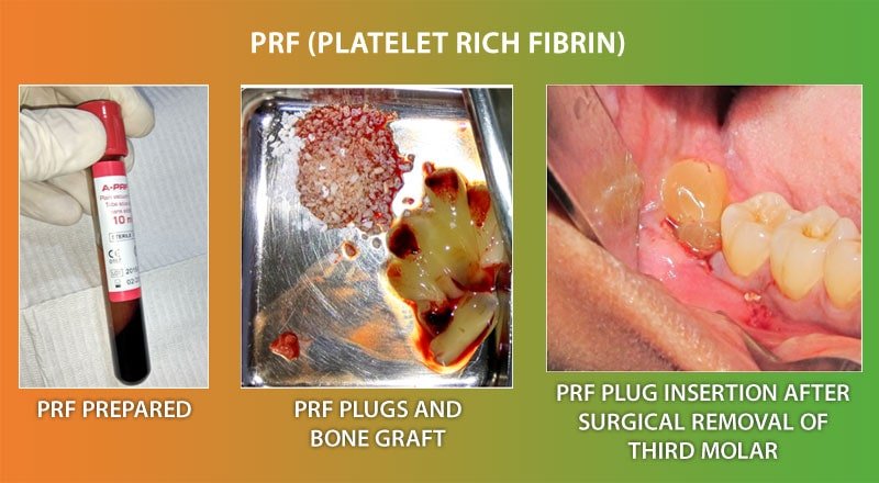 Dental Advacned Technology PRF